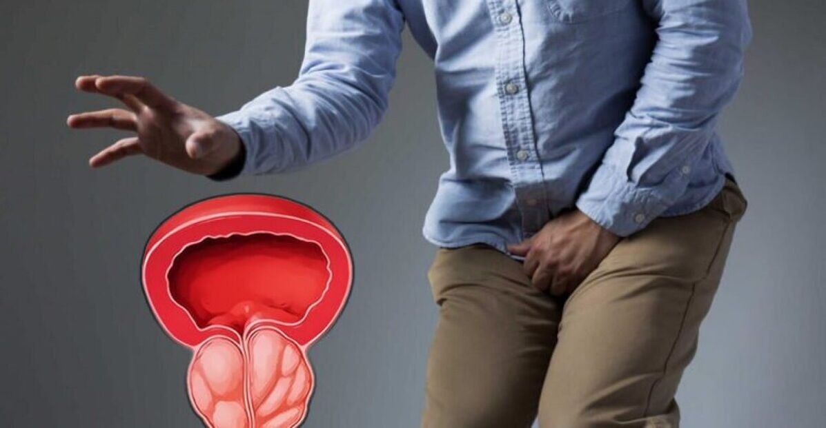 Symptoms and signs of prostatitis