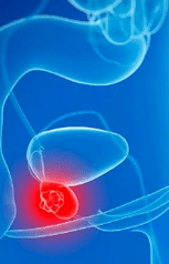 Prostatitis