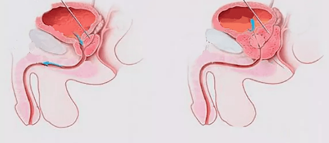 Signs of prostatitis in men