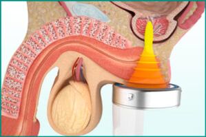 Treatment of prostatitis