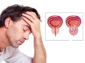 Prostatitis in a man